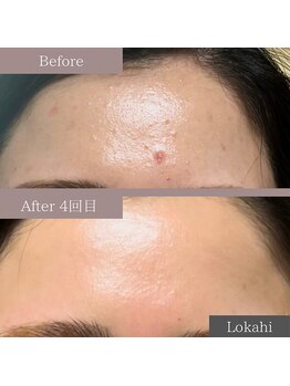 ロカヒ(Lokahi)/水光肌ピーリング
