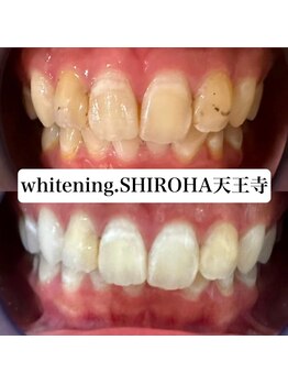 シロハ(SHIROHA)/セルフホワイトニング/天王寺