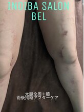 ベル(BEL)/術後ケアは適切な施術を！