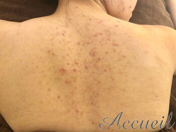 アクール(Accueil)/背中の肌荒れにも効果◎１