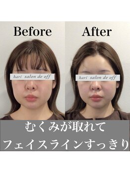 ハリサロンドオフ 心斎橋店(hari salon de off)/ダウンタイムにも！