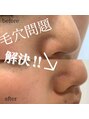 ディアメ(Diame) 鼻のお悩みケアできます！鼻みられてますよ♪
