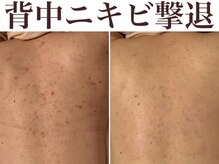 マヴィ(Ma vie)の雰囲気（夏に向けて背中美人へ♪ひつこい背中ニキビケアも最短で可能◎）