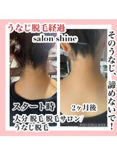 サロンシャイン(Salon Shine)/うなじ脱毛の経過