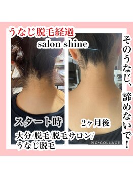 サロンシャイン(Salon Shine)/うなじ脱毛の経過
