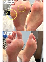 リゼラアンドコー 川越南古谷店/多数の魚の目も料金一律で安心