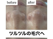 ブルーシー(BLUESEA)/毛穴洗浄