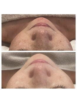 美温(mion)/極み180 フェイシャルケア