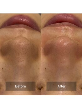 マヴィ(Mavie)/韓国式3D毛穴洗浄