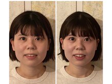 ドクター ヴィーナス/小顔矯正モニター