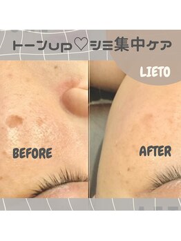 リエート(LIETO)/【人気NO.1！シミ集中ケア】