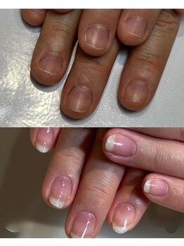 ティアラネイル 宇都宮/深爪矯正