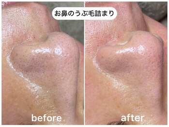 フラックス 京都(FLUX)/【ワックス脱毛】お鼻のうぶ毛