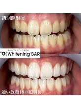 ホワイトニングバー 町田店/通い放題ビフォーアフター