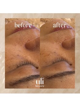 ウリ(uli beauty)/比較写真