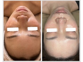 美しぐれ 溝の口店/【4回】LDM/インモード/MTS