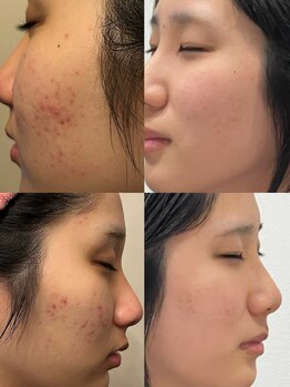 ビー イオンモール小山店(Be...)/肌質改善事例