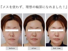 エピファニー(Epiphany)/20代　悩みだった顔の長さが…