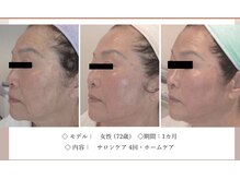 エテル(eter)/エクスビアンPHA水光ピール 