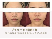 ルナビューティー 赤坂(LUNA beauty)/肌育てるピーリング/プラピール