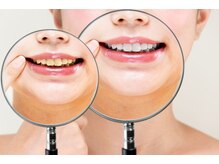 ビーバイビー(BBYB)/歯の色で印象は変わります♪