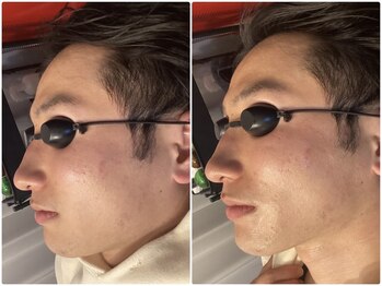 肌レボ 池袋店(肌REVO)/光フォトの効果がすごすぎる