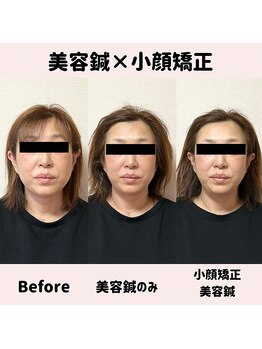 ワッカ 広尾(WACCA)/美容鍼×小顔矯正BeforeAfter 2