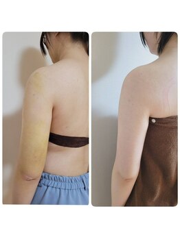 サロン ポム(salon pom)/◇二の腕術後インディバ◇