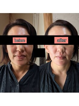 スノードロップ(snowdrop)/フェイシャルは小顔施術付き