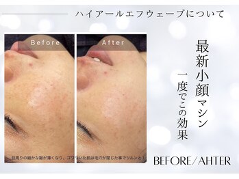 ユアーズ ビューティー(YOURS beauty)/1回で理想の小顔に☆