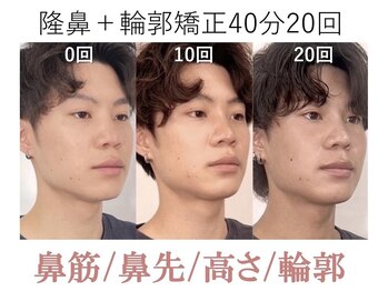 ラプリ 梅田店(Raplit)/隆鼻＋輪郭矯正40分20回