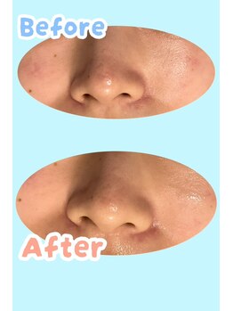 ヴィコロン(Vicolone)/毛穴洗浄施術前後写真その２