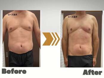 メディカルエステサロン ローズ 金沢本店(ROSE)/メンズ痩身ビフォーアフター