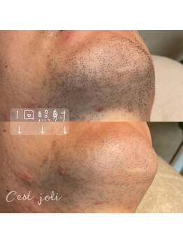 セジョリ(C'est joli)/ヒゲ脱毛モニター様《熊本》