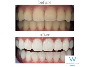 ホワイトニングショップ 新潟店/ホワイトニングビフォーアフター
