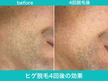 ミスターアンクール 鹿児島(Mr.uncoeur)/ヒゲ脱毛4回後