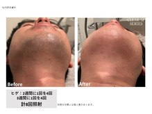 ラッシュ(RUSH)/8回で青ヒゲ卒業！