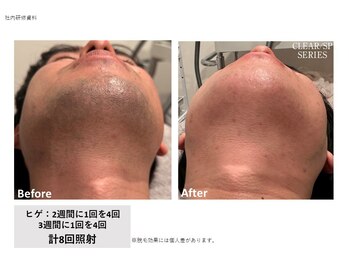 ラッシュ(RUSH)/8回で青ヒゲ卒業!