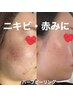 ［ニキビ・赤み・赤ニキビ］肌質改善ツルツル激変ハーブピーリング/16500円→