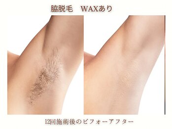 ミリ(MiLi)/脇脱毛