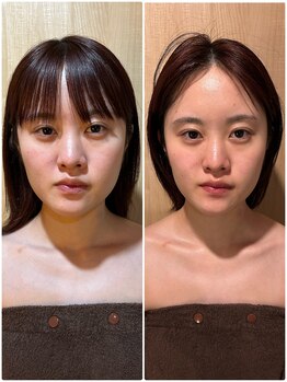 アグレア(Agrea)/頭蓋骨小顔矯正1回の施術♪