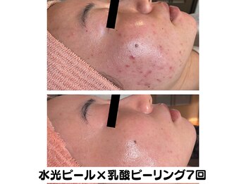 ラディアント たまプラーザ/水光ピール×乳酸ピーリング