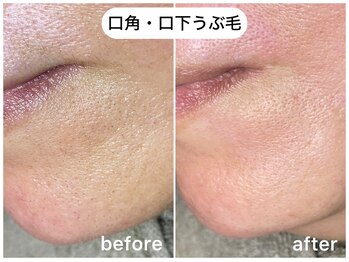 フラックス 京都(FLUX)/【ワックス脱毛】口下うぶ毛
