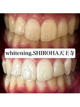 シロハ(SHIROHA)/セルフホワイトニング/天王寺