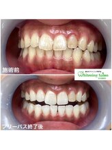 ホワイトニングサロン 名古屋駅店/【ホワイトニング施術例】