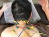 【ガチガチの首肩コリは鍼灸で解消】整体+鍼灸電気鍼 60分¥3289 毎月15名