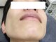 ハダハダ(HADA HADA Medical Esthetic)の写真/痛いヒゲ脱毛のイメージを変える！！《★最先端の最新脱毛機は【しんどくないヒゲ脱毛】★》お試し2000円◎