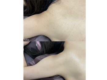 チェルト 鈴鹿店(CERTO)/背中上部、二の腕もケア★