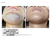 ラッシュ(RUSH)/10年悩んだ青ヒゲがツルツルに！