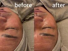 ベル(Belle)/ニードルピーリング1回の効果！